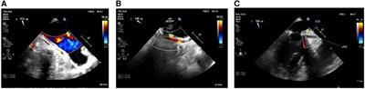 When too much closeness harms: circumflex artery injury during mitral valve surgery